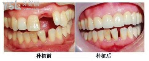 種植牙是真牙還是假牙？