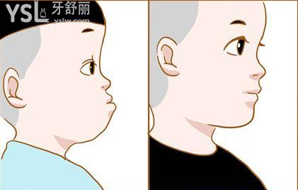 地包天.png