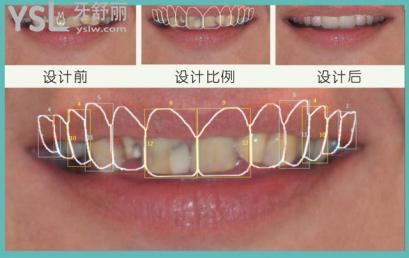 貼面需要磨牙嗎，做貼面對(duì)牙齒有傷害嗎？