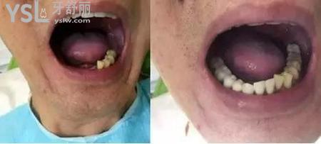 種植牙后可以吃東西嗎？