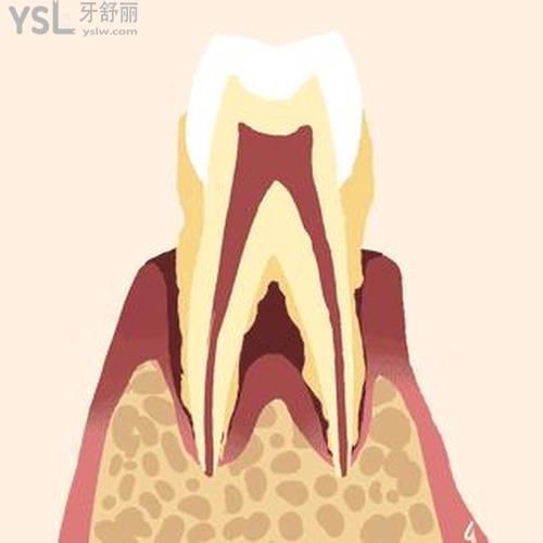 牙齒松動3度需要拔掉嗎？