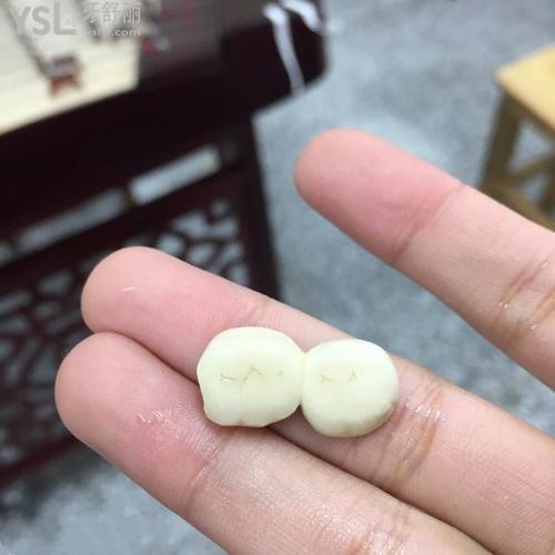 27歲做了16顆烤瓷牙，我后悔了