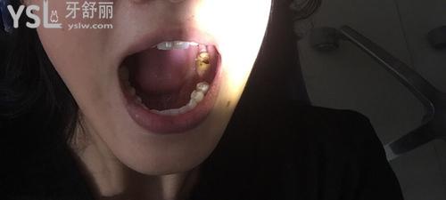 27歲做了16顆烤瓷牙，其中兩顆門牙讓我后悔了