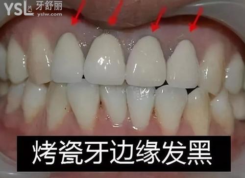 27歲做了16顆烤瓷牙