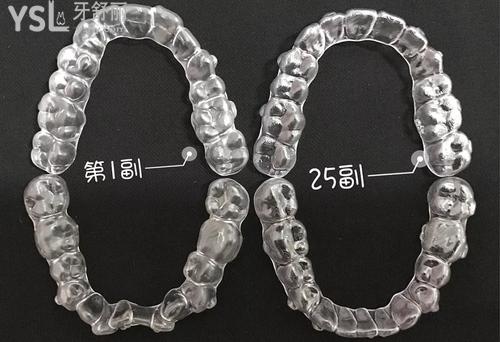 隱形矯正牙齒的過(guò)程