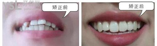 隱形矯正成效怎么樣