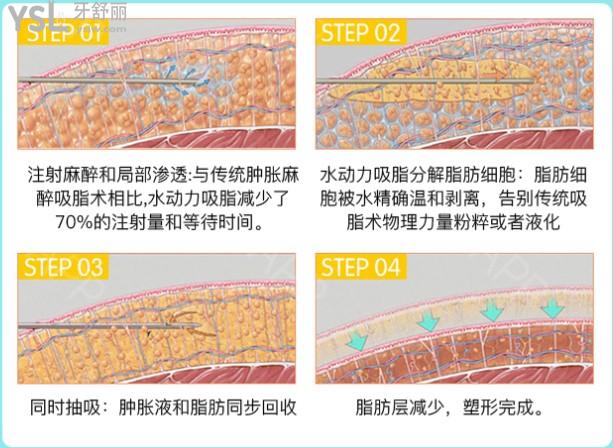 杭州時(shí)光醫(yī)療美容醫(yī)院吸脂手術(shù)