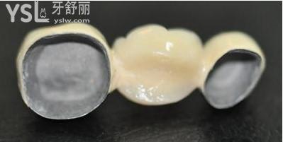 鈷鉻內冠烤瓷牙