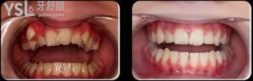 兒童mrc矯正器成效