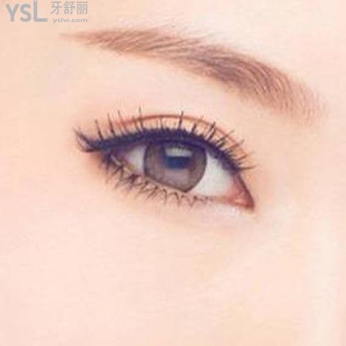 開雙眼皮后注意什么？
