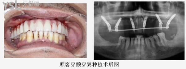 穿顴穿翼種植牙術(shù)后