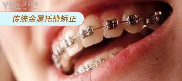 金屬牙套
