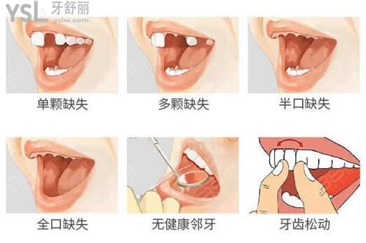 zimmer種植體價(jià)格高，它值那個(gè)價(jià)嗎？.jpg