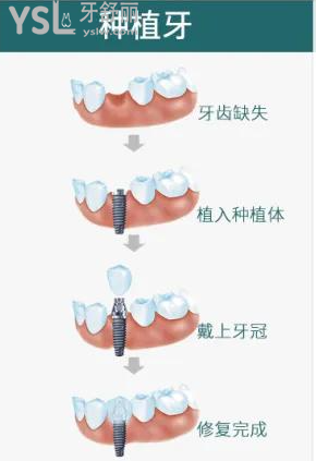 連續(xù)缺失三顆牙齒要怎么辦
