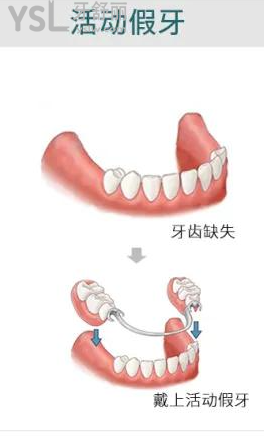 連續(xù)缺失三顆牙齒要怎么辦