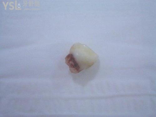 牙掉了**時間該怎么處理？我勸你趕緊去醫(yī)院