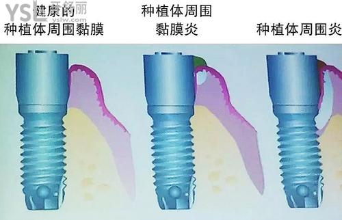 種植體周?chē)讜?huì)隨時(shí)間加重嗎？5個(gè)答案幫助你！