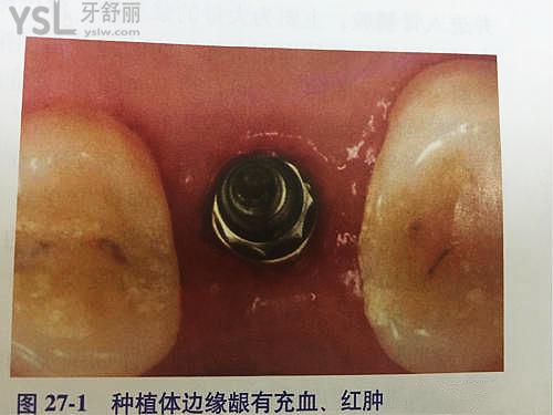 種植體周?chē)讜?huì)隨時(shí)間加重嗎1