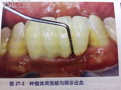 種植體周?chē)讜?huì)隨時(shí)間加重嗎2