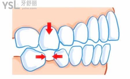 長(zhǎng)期缺牙不管導(dǎo)致牙縫大