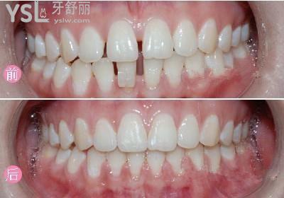 牙齒正畸矯正解決牙縫大問(wèn)題