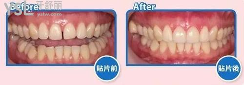 30歲牙縫大矯正前后對(duì)比圖1