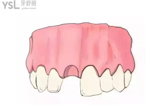 鑲牙