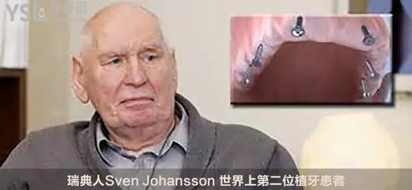 諾貝爾種植體受術(shù)者