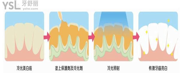 冷光美白治療過程