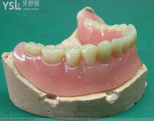 活動假牙種類及價格及特點