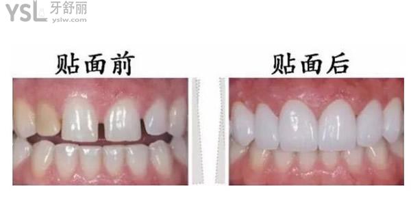 牙貼面對比圖