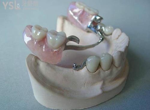 可摘局部義齒