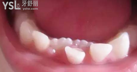 小孩子門(mén)牙沒(méi)掉從牙根又出兩牙