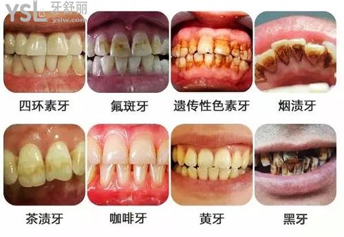 牙齒色素