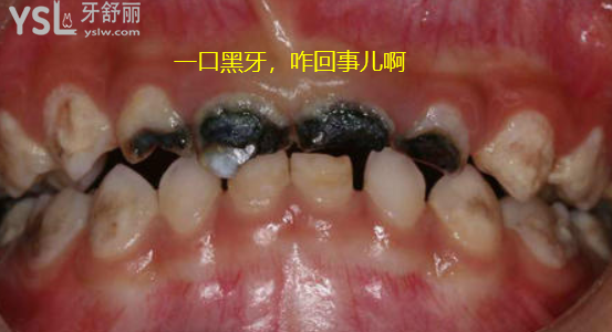 牙齒發(fā)黑怎么是什么原因