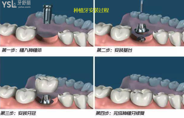 假牙怎么做上去的
