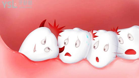導(dǎo)致牙齒松動(dòng)與脫落主要的疾病是什么？