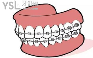 20歲的年輕人做牙套要做什么的