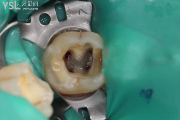 牙齒根管治療一直流血是什么原因？