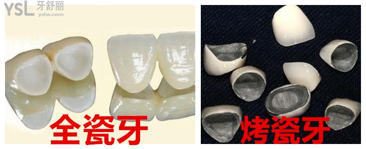 全瓷牙和烤瓷牙對比圖