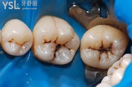 齲洞