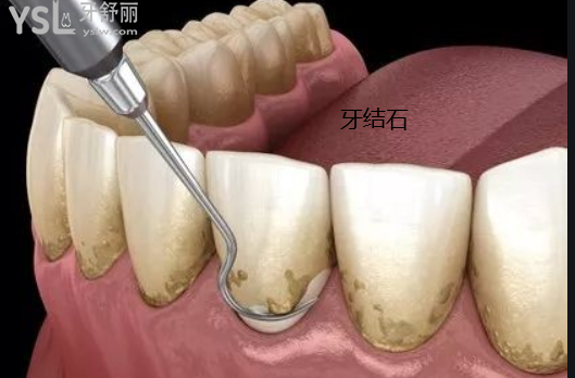老年人牙齒掉了一部分原因