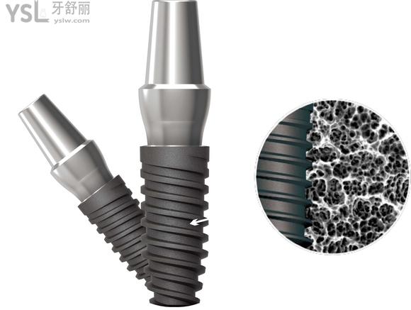諾貝爾種植體replace沒有被淘汰