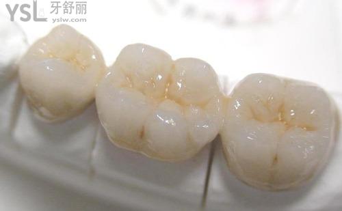 鑲牙