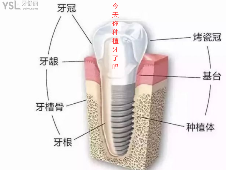中年人牙齒脫落后如何處理