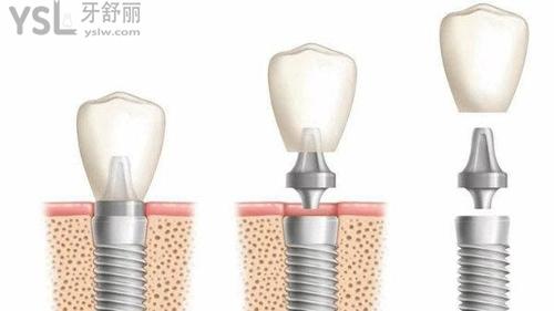 登騰與奧齒泰區(qū)別在哪里