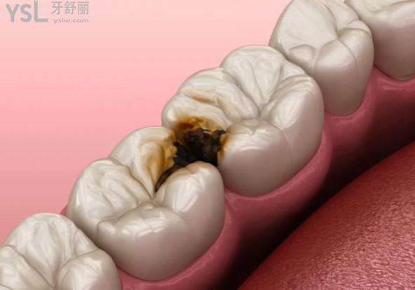牙縫細(xì)菌通過超聲波洗牙