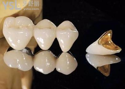 缺一顆牙齒怎么補好2