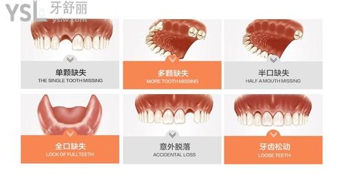 缺一顆牙齒怎么補好3