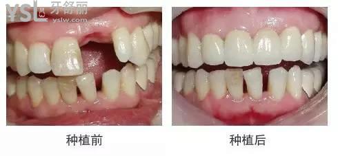 缺一顆牙齒種植牙修復成效